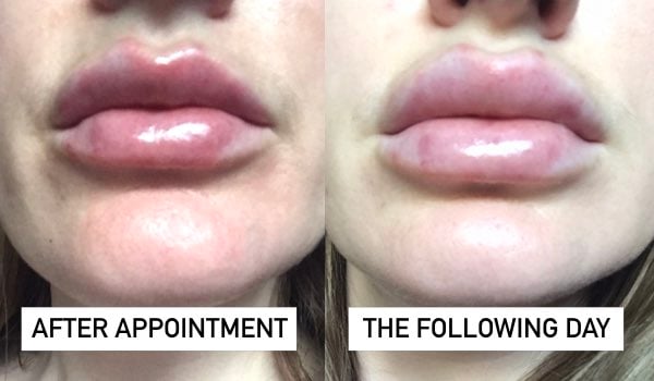 lip filler what it's like review