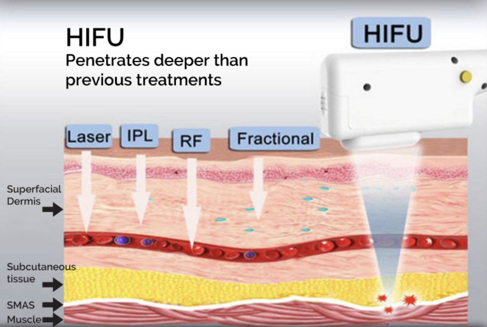 what is HIFU 